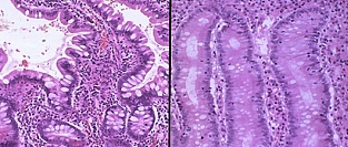 Целиакия. Информация для пациентов