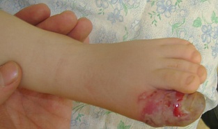 Герпетический панариций. Седьмой день болезни