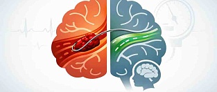Ишемический инсульт. Рекомендации AHA/ASA 2026