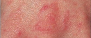 Чесотка. Описание элементов сыпи.