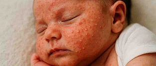 Акне новорождённых (младенческие угри, неонатальный пустулёз)