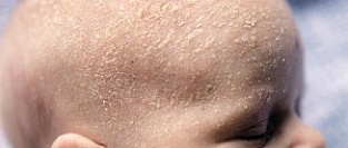 Себорейный дерматит (молочный струп). Описание элементов.