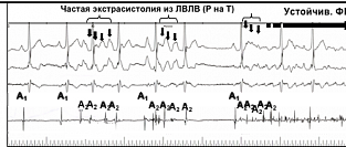 Влияние факторов риска на сохранение синусного ритма при фибрилляции предсердий