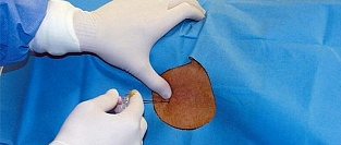 Эпидуральная анестезия. О частоте осложнений