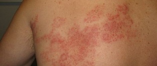 Герпес-вирусные инфекции