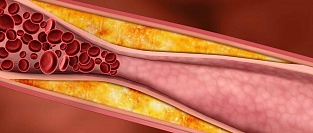 Статины при атеросклерозе периферических артерий. Влияние на судьбу конечности