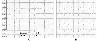 Новая стратегия снижения частоты кровотечений при ЧКВ у пациентов с фибрилляцией предсердий