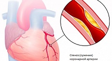 Коронарография сердца — что такое и что показывает коронарное обследование сосудов сердца