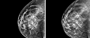 Маммография в оценке поражения коронарных артерий