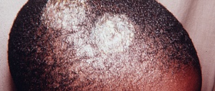 Стригущий лишай (грибковое поражение кожи). Описание элементов сыпи.