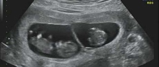 Двойня. Оптимальный срок для родов