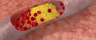 Холестерин и сахарный диабет. Неожиданная ассоциация