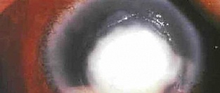 Бактериальный кератит. О раннем назначении стероидов