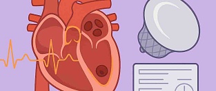 Закрытие ушка левого предсердия