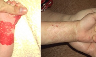 Гемангиома. Результат удаления лазером