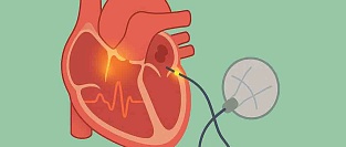 Радиочастотная абляция при мерцательной аритмии