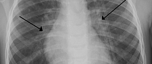 Бронхиолит. Симптомы, диагностика, лечение