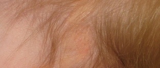 Поражения волосистой части головы у детей