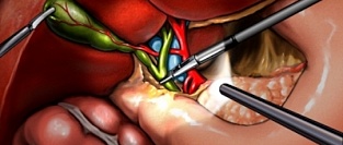 Профилактическая антибиотикотерапия после холецистэктомии и частота послеоперационных инфекций