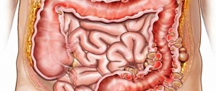 Мифы о дивертикулезе и дивертикулите