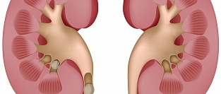Мочекаменная болезнь и риск сердечнососудистых заболеваний