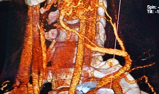 Артериовенозная мальформация