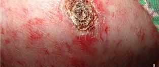 Метод лечения младенческих гемангиом пропранололом получил одобрение FDA