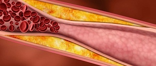 Холестерин. Новости биобанка Великобритании