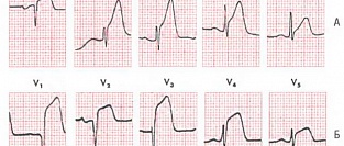 Рекомендации ESC по инфаркту миокарда с подъемом сегмента ST 2017