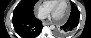 AHA о лучевой диагностике заболеваний сердца