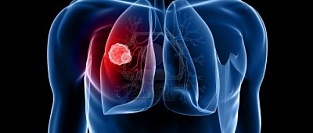 Туберкулез. Рекомендации по диагностике и лечению 2017